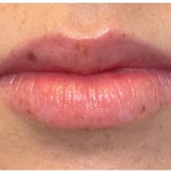 Dermal Fillers Before & After Patient #957