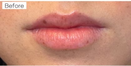 Dermal Fillers Before & After Patient #957