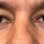 Morpheus8 Before & After Patient #958