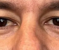 Morpheus8 Before & After Patient #958
