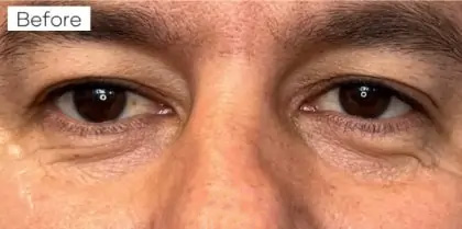 Morpheus8 Before & After Patient #958