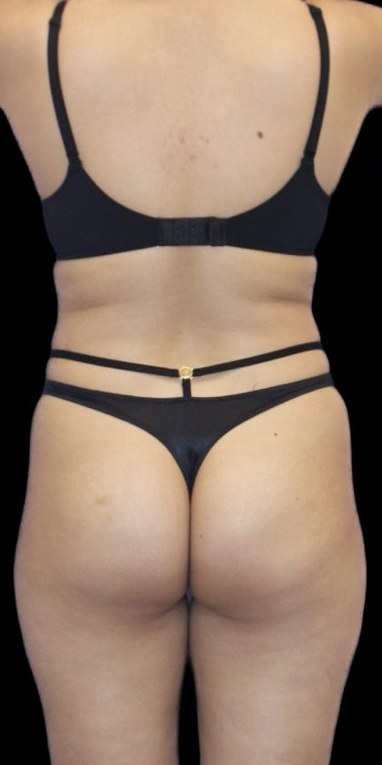 Brazilian Butt Lift Before & After Patient #403