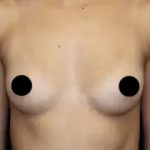Breast Augmentation Before & After Patient #490