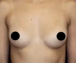 Breast Augmentation Before & After Patient #490