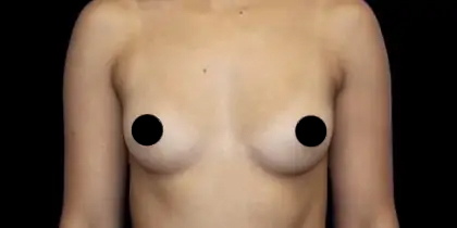 Breast Augmentation Before & After Patient #490