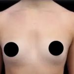 Breast Augmentation Before & After Patient #491