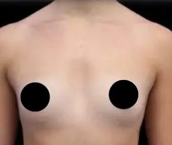 Breast Augmentation Before & After Patient #491