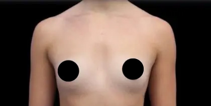 Breast Augmentation Before & After Patient #491
