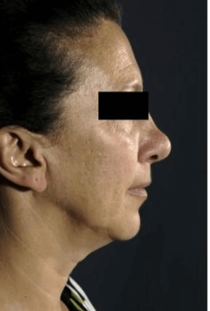 Neck Lift Before & After Patient #633
