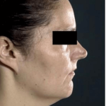 Neck Lift Before & After Patient #634