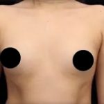 Breast Augmentation Before & After Patient #492