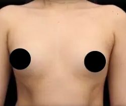 Breast Augmentation Before & After Patient #492