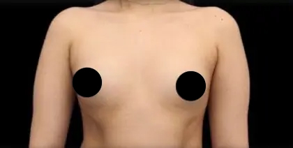 Breast Augmentation Before & After Patient #492