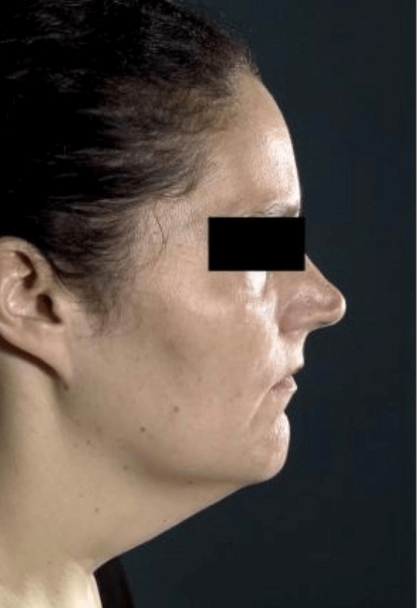 Neck Lift Before & After Patient #634