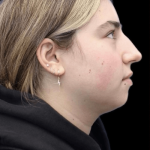 Primary Rhinoplasty Before & After Patient #806