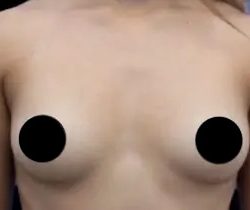 Breast Augmentation Before & After Patient #493