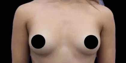 Breast Augmentation Before & After Patient #493