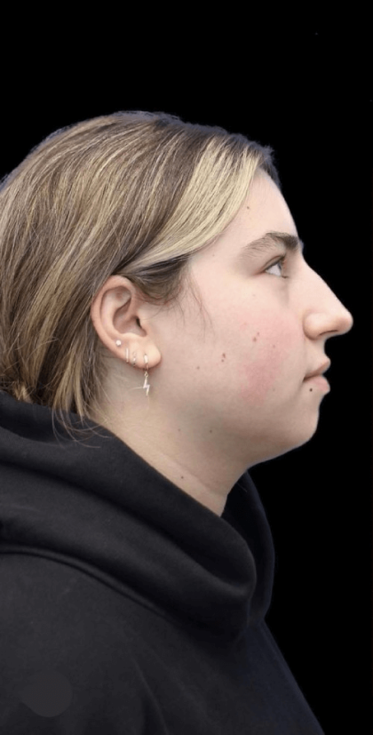 Primary Rhinoplasty Before & After Patient #806