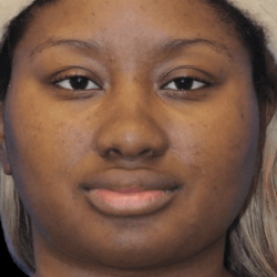 Primary Rhinoplasty Before & After Patient #823