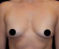 Breast Augmentation Before & After Patient #496