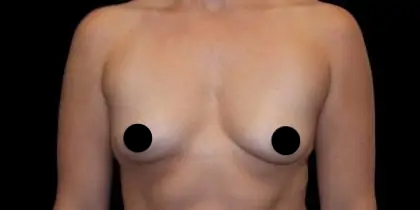 Breast Augmentation Before & After Patient #496