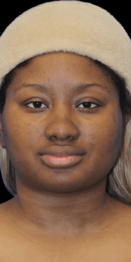 Primary Rhinoplasty Before & After Patient #823