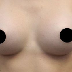 Breast Augmentation Before & After Patient #424