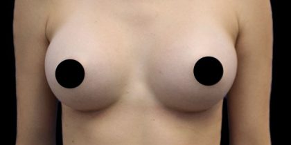 Breast Augmentation Before & After Patient #424