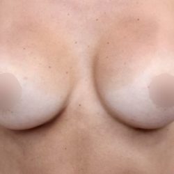Breast Augmentation Before & After Patient #500