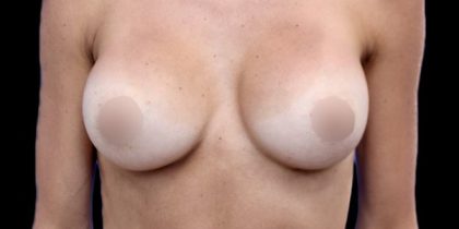 Breast Augmentation Before & After Patient #500