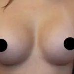 Breast Augmentation Before & After Patient #501