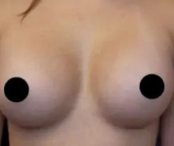 Breast Augmentation Before & After Patient #501