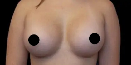 Breast Augmentation Before & After Patient #501