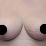 Breast Lift Before & After Patient #534