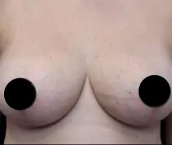 Breast Lift Before & After Patient #534