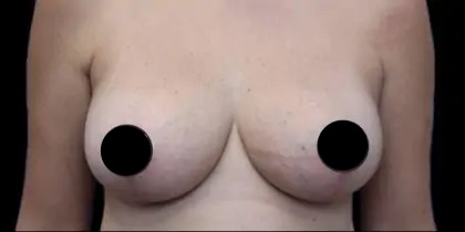Breast Lift Before & After Patient #534