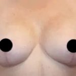Breast Lift Before & After Patient #535
