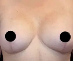 Breast Lift Before & After Patient #535