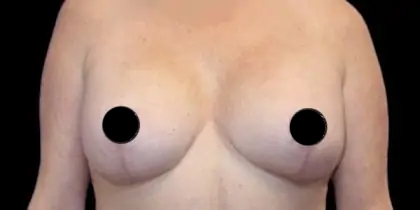 Breast Lift Before & After Patient #535