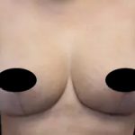 Breast Lift Before & After Patient #536