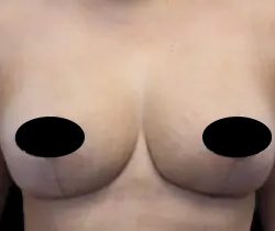 Breast Lift Before & After Patient #536