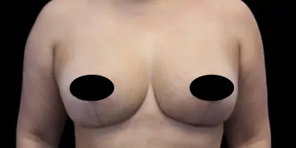 Breast Lift Before & After Patient #536