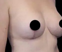 Breast Lift Before & After Patient #537