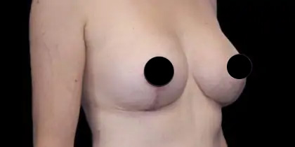 Breast Lift Before & After Patient #537