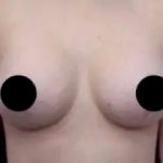 Breast Lift Before & After Patient #539
