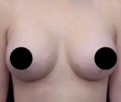 Breast Lift Before & After Patient #539