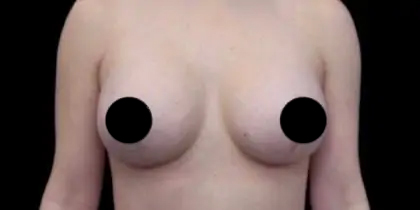 Breast Lift Before & After Patient #539