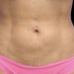 Liposuction/Liposculpture Before & After Patient #598