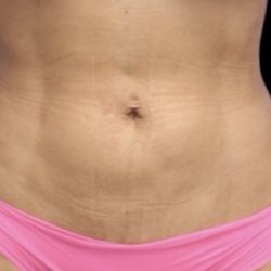 Liposuction/Liposculpture Before & After Patient #598