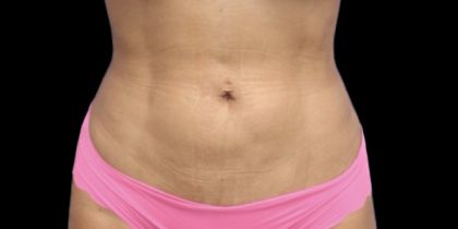 Liposuction/Liposculpture Before & After Patient #598